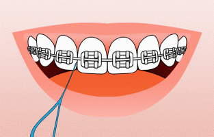 flossing with braces